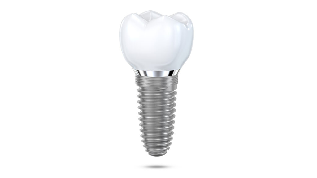 dental implants