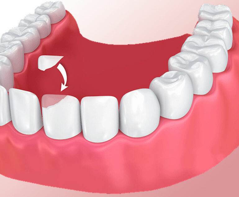 Dental Bonding