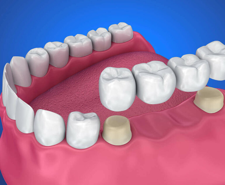 Dental Bridge