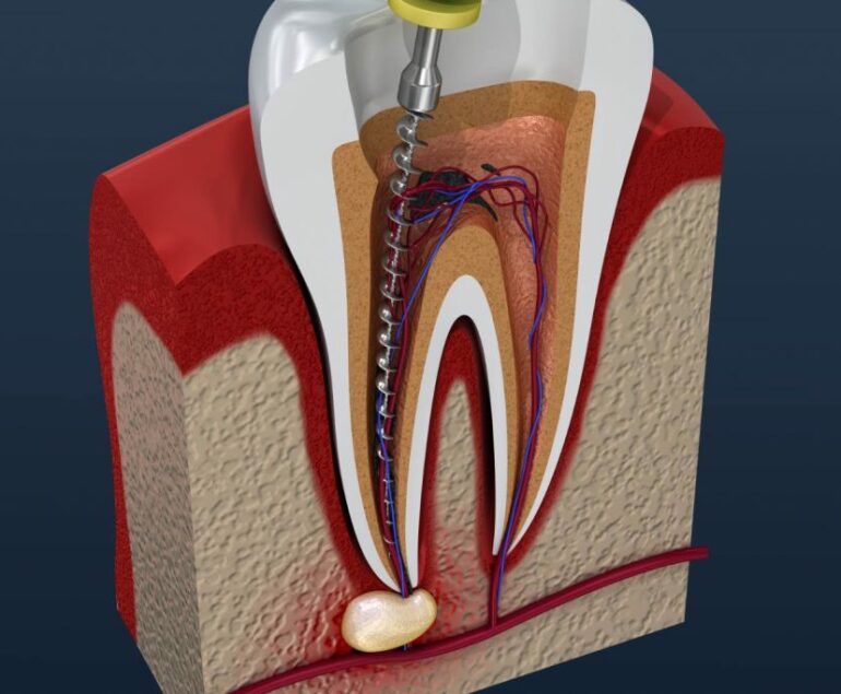 Root Canal Therapy